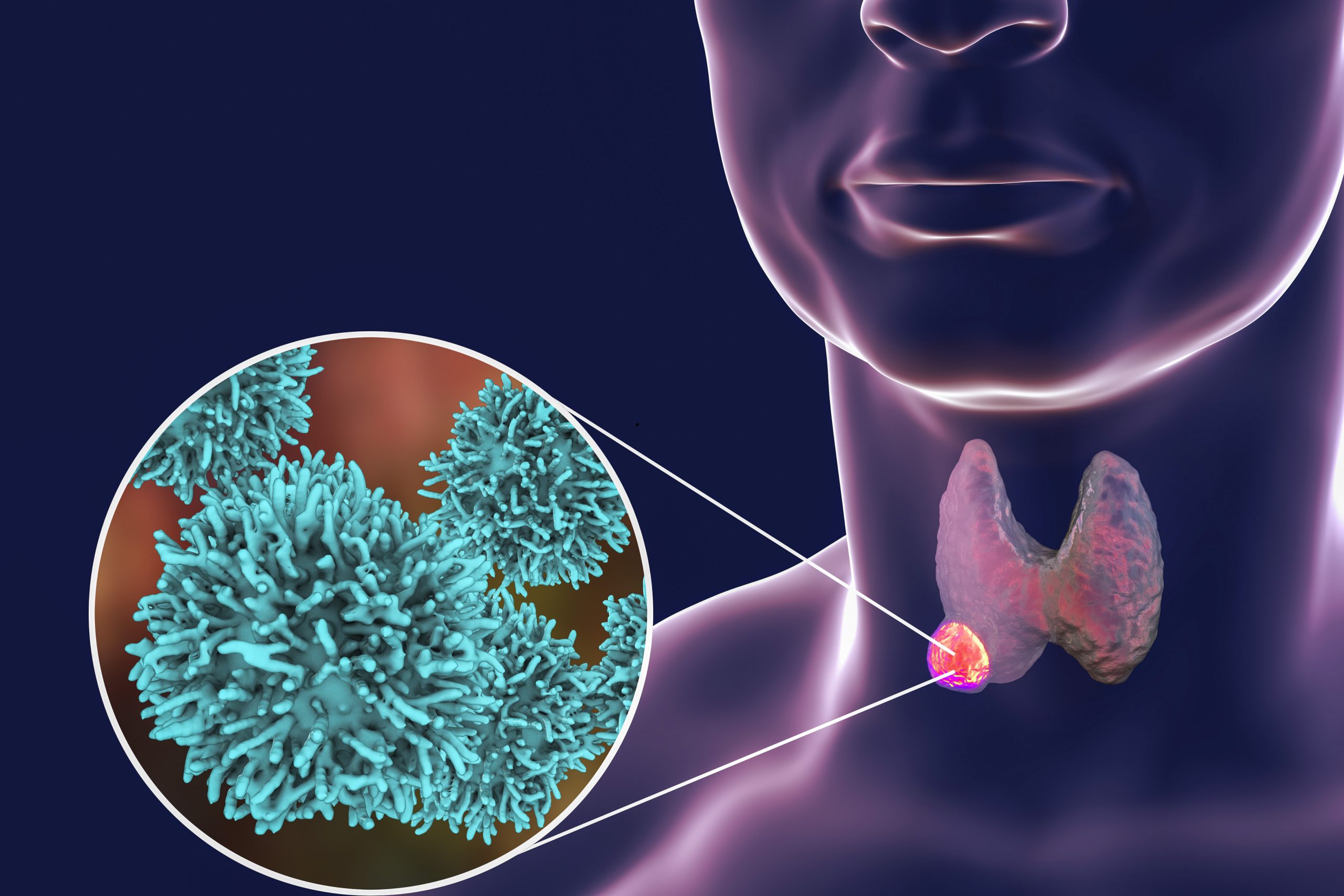 Thyroid cancer. 3D illustration showing thyroid gland with tumor inside human body and closeup view of thyroid cancer cells